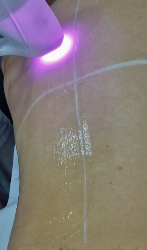 depilacion laser madrid